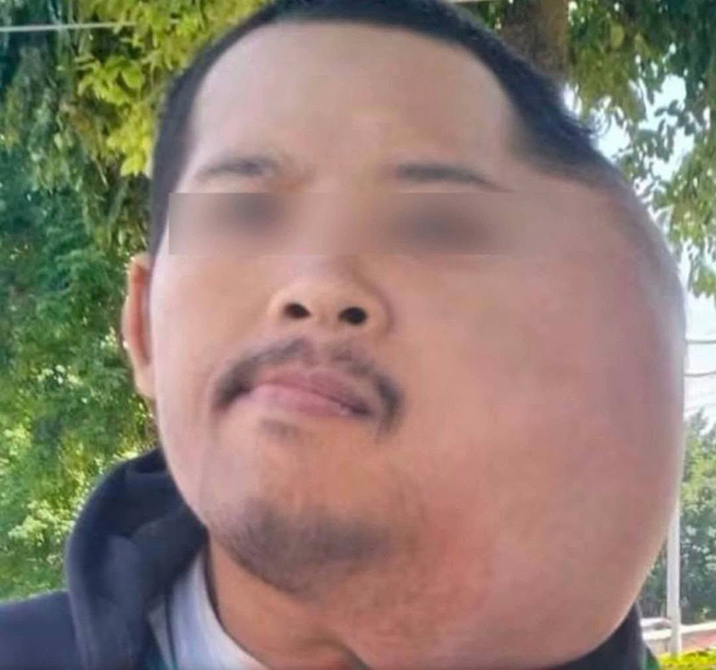 หนุ่มป่วยใบหน้าบวมครึ่งซีก