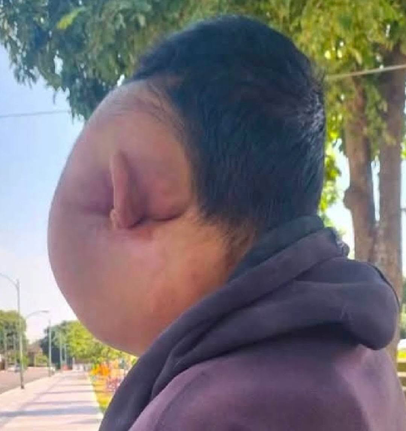 หนุ่มป่วยใบหน้าบวมครึ่งซีก