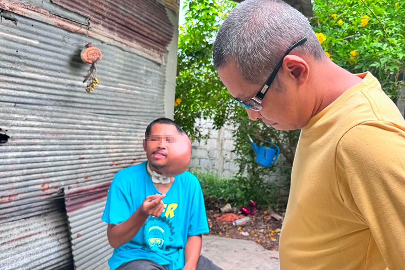 หนุ่มป่วยใบหน้าบวมครึ่งซีก