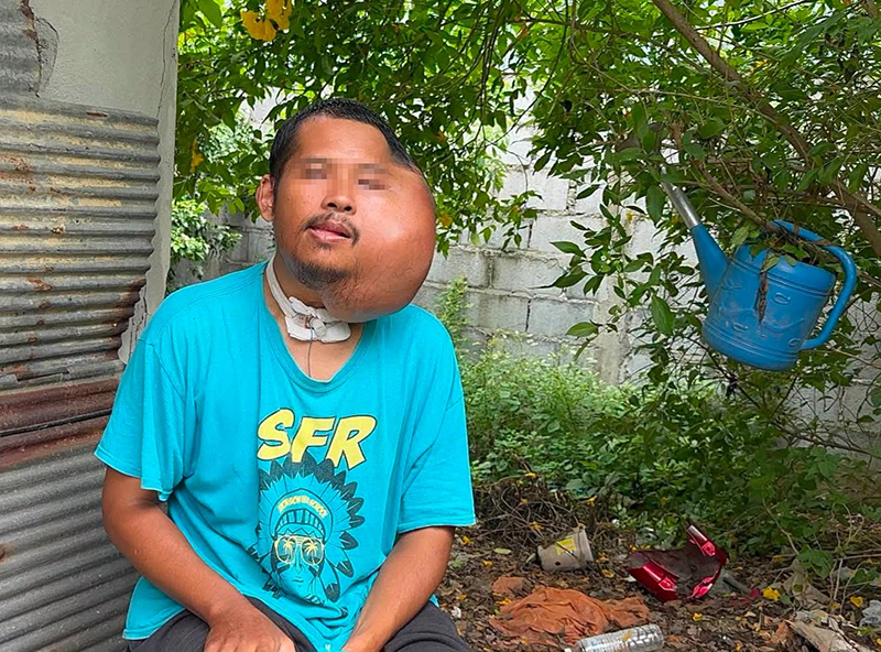 หนุ่มป่วยใบหน้าบวมครึ่งซีก