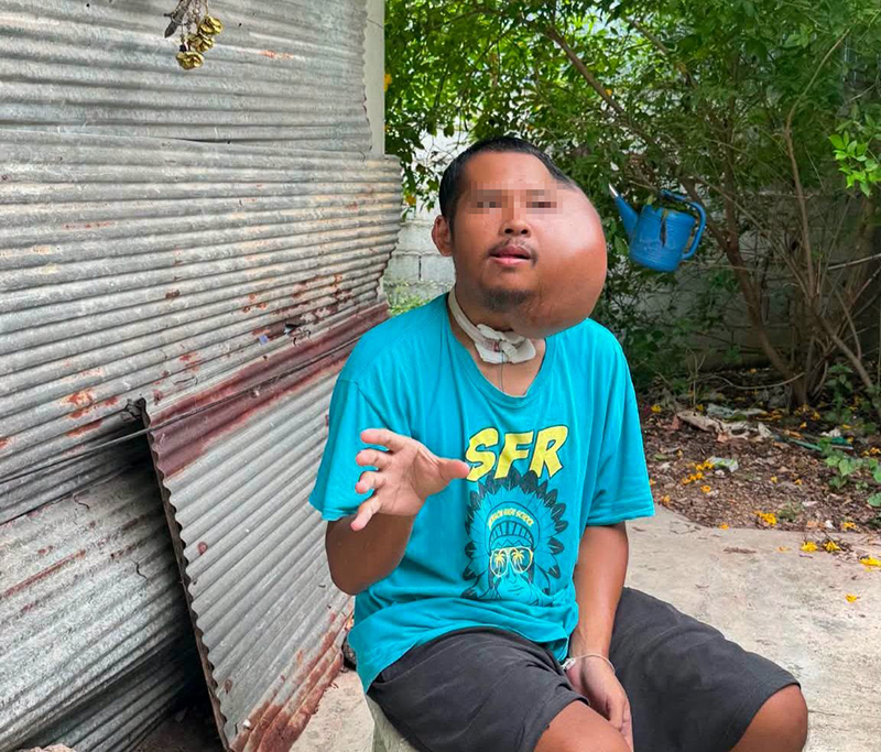หนุ่มป่วยใบหน้าบวมครึ่งซีก