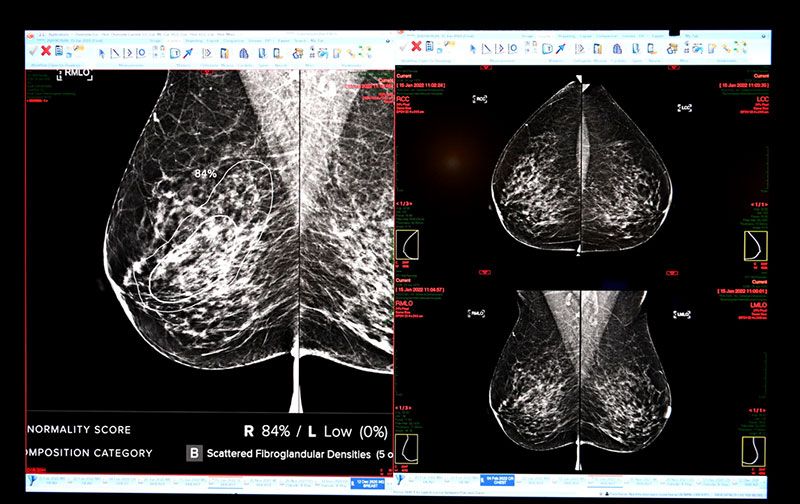 AI วิเคราะห์ มะเร็งเต้านมจากภาพแมมโมแกรม

