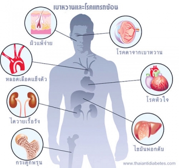 เผยผลสำรวจเบาหวานน่าตกใจ คนไทยกว่า 2 ล้านคนไม่รู้ตัวว่าป่วย