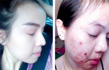 ภัยร้ายที่มาพร้อมเครื่องสำอาง อย่าสนคำโฆษณา ‘ขาวไว ทันทีที่ใช้’