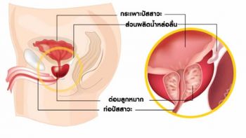 เทคโนโลยีใหม่ลดปัญหาปัสสาวะเล็ด  ด้วยเครื่องบริหารกล้ามเนื้ออุ้งเชิงกราน
