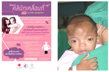คลินิกเคลื่อนที่ช่วยเหลือผู้พิการบนใบหน้าและกะโหลกศีรษะ  เฉลิมพระเกียรติ สมเด็จพระเทพรัตนฯ 63 พรรษา 2 เมษายน 2561