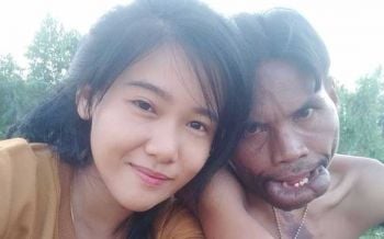 หมอศัลยกรรมยื่นมือช่วย\'มีมี่\'หนุ่มหน้าพิการ ไม่มีค่าใช้จ่าย-เจ้าตัวอยู่ระหว่างตัดสินใจ