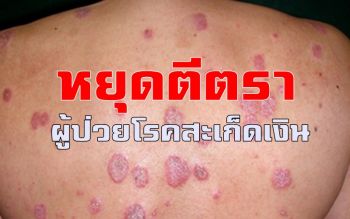 สถาบันโรคผิวหนัง ชวนสังคมไทย \'หยุดตีตรา ผู้ป่วยโรคสะเก็ดเงิน\'