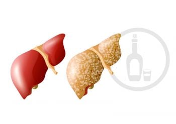 LFE&HEALTH : ‘ไขมันพอกตับ’ภัยเงียบทำลายสุขภาพ