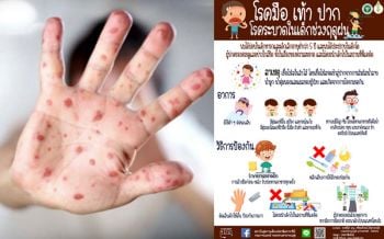 แพทย์เตือน! โรค ‘มือ-เท้า-ปาก’พบมากในเด็กช่วงฤดูฝน