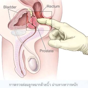 มะเร็งต่อมลูกหมากรู้ไวเพิ่มโอกาสหายขาด  ด้วยเทคโนโลยีตัดชิ้นเนื้อโดยใช้ภาพเอกซเรย์คลื่นแม่เหล็ก