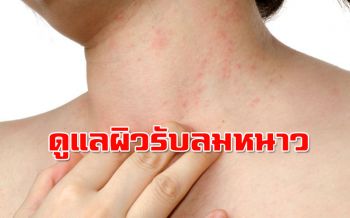 แพทย์แนะวิธีดูแลผิวหนังรับลมหนาว