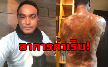 \'วินัย ไกรบุตร\'โพสต์เฟสบุ๊ค\'ลองสู้อีกสักตั้ง\' หลังอาการตุ่มน้ำพองกำเริบหนัก