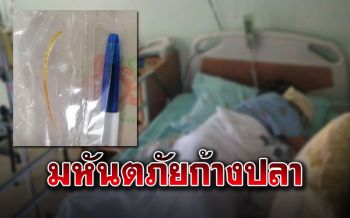 เตือนภัย!! หญิงวัย63ปวดท้องเกือบเดือน ผงะ..ก้างปลาทิ่มลำไส้เล็กอักเสบ