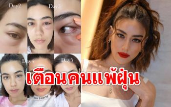 \'คิมเบอร์ลี่\'แชร์อุทาหรณ์ แพ้ฝุ่น PM 2.5 จนตาบวม