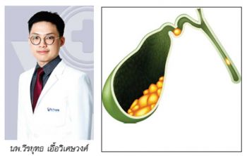 อย่าเข้าใจผิด!! นิ่วในถุงน้ำดี ไม่สามารถสลายนิ่วได้