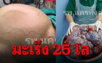 หมั่นเช็คสุขภาพ! หมอไทยเปิดประสบการณ์ ผ่าตัด\'มะเร็งรังไข่\'ขนาดยักษ์
