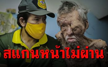 วอนช่วย\'ลุงตุ่ม\'ป่วยเท้าแสนปม ครอบครัวยากจนสแกน\'ไทยชนะ\'ไม่ผ่าน