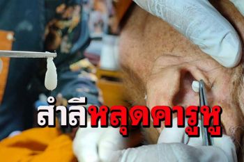 อุทาหรณ์หลวงตาใช้คอตตอนบัดปั่นทำความสะอาดสำลีหลุดติดคารูหู