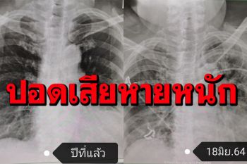 หมอรพ.สมิติเวชเผยภาพเอกซเรย์ของผู้ป่วยโควิด ที่ยังไม่ได้ฉีดวัคซีน พบปอดเสียหายหนัก