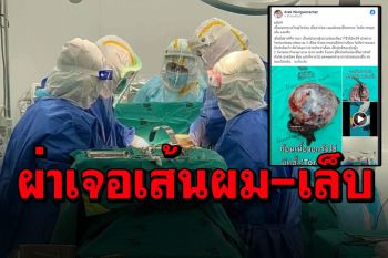 หมอเมืองคอนโพสต์ตลึง! ผ่าตัดเนื้องอกใหญ่ในท้อง เจอเส้นผมไขมัน กระดูกเล็บฟัน