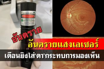 อันตราย\'เลเซอร์\'ยิงใส่ตา เผยเจอคนไข้แผลไหม้กระทบมองเห็น-เก็บให้พ้นมือเด็ก