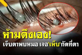 สุดสะพรึง! อุทาหรณ์ \'คนรักสัตว์\' เจ็บตาหนัก พบหมอเจอ \'เห็บ\' กัดที่ตา