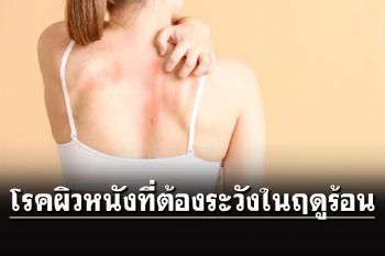 LIFE & HEALTH : โรคผิวหนังที่ต้องระวังในฤดูร้อน