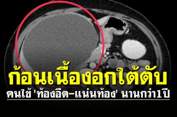 คนไข้ \'ท้องอืด-แน่นท้อง\' นานกว่า1ปี ตรวจเจอก้อนเนื้องอกใต้ตับขนาดใหญ่