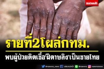 สธ.พบผู้ป่วย\'ฝีดาษลิง\'รายที่ 2 โผล่กรุงเทพฯ ติดตามกลุ่มเสี่ยงอีก 10 คน