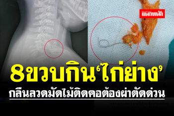 อุทาหรณ์! \'หมออารักษ์\' เตือน 8 ขวบกินไก่ย่าง กลืนลวดมัดไม้ติดคอต้องผ่าตัดด่วน