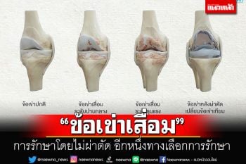 การรักษาข้อเข่าเสื่อมโดยไม่ผ่าตัด อีกหนึ่งทางเลือกการรักษา