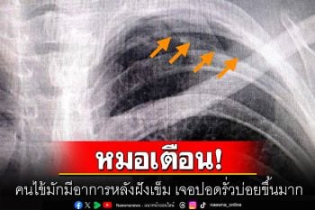 หมอเตือน! คนไข้มักมีอาการหลังฝังเข็ม เจอปอดรั่วบ่อยขึ้นมาก ชี้สาเหตุที่พบบ่อยคือ\'ประมาท\'