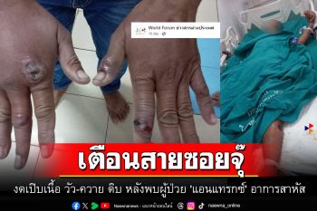 เตือนสายซอยจุ๊งดเปิบเนื้อ วัว-ควาย ดิบ หลังพบผู้ป่วย \'แอนแทรกซ์\' อาการสาหัส