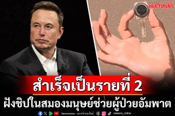 \'Neuralink\'ฝังชิปในสมองมนุษย์รายที่2สำเร็จ ช่วยผู้ป่วยอัมพาตให้มีพลังเหนือมนุษย์