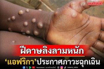 แอฟริกาประกาศภาวะฉุกเฉิน! \'ฝีดาษลิง\'ระบาดข้ามชายแดน กระทบแล้วหลายพันชีวิต