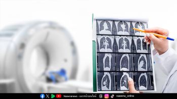 Health News : ผู้ป่วยมะเร็งปอด’ ถึง 1 ใน 5 ไม่สูบบุหรี่