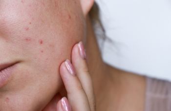 M Vita Clinic คลินิกรักษาสิว ที่เข้าใจปัญหาสิวทุกรูปแบบ