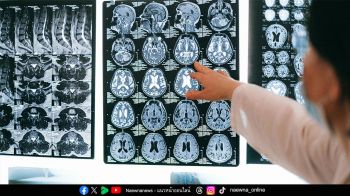 ‘สโตรกสมอง’ คร่าชีวิตคนไทยทุก 10 นาที รู้ทัน BEFAST ลดเสี่ยงพิการ-เสียชีวิต