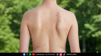 หน้าหนาว แต่แดดแรง ระวัง ‘มะเร็งผิวหนัง’ โรคใกล้ตัวที่ไม่ควรมองข้าม