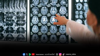 ‘สโตรกสมอง’ คร่าชีวิตคนไทยทุก 10 นาที  รู้ทัน BEFAST ลดเสี่ยงพิการ-เสียชีวิต