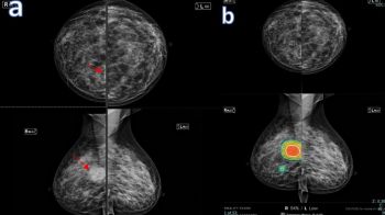 Health News : AI ช่วยพบความเสี่ยงมะเร็งเต้านม