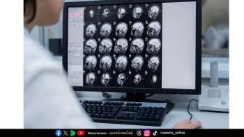 แพทย์เตือน ‘สโตรก’ เพียง 1 นาที สูญเสีย 1 ล้านเซลล์สมอง วัยทำงานเสี่ยงพุ่ง