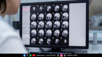 ‘1 นาที สูญเสีย 1 ล้านเซลล์สมอง’ ภัยร้าย ‘สโตรก’ เกิดขึ้นได้กับทุกคนแม้สุขภาพแข็งแรง วัยทำงานเสี่ยงพุ่ง