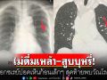 \'หมอมนูญ\'เปิดเคสคนไข้ไม่ดื่มเหล้า-สูบบุหรี่ เอกซเรย์ปอดเห็นก้อนเล็กๆ สุดท้ายพบวัณโรค