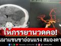 ไม่ใช่ใครก็นวดได้! เปิดเคส ชายแขนขาอ่อนแรง สมองตาย หลังให้ภรรยานวดคอ
