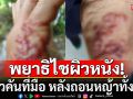 ขนลุก! มีอาการคันที่มือ หลังถอนหญ้าทั้งวัน สุดท้ายหมอระบุ\'พยาธิไชผิวหนัง\'