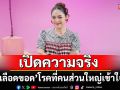 เปิดความจริง \'เส้นเลือดขอด\' โรคที่คนส่วนใหญ่เข้าใจผิด! ปล่อยไว้เสี่ยงติดเชื้อรุนแรง