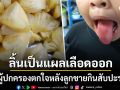 คอมเมนต์สนั่น ผู้ปกครองโพสต์ลูกชายกินสับปะรดแล้วลิ้นเลือดออก หมอดังรีบออกมาเบรกดราม่า