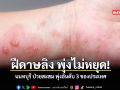ฝีดาษลิง พุ่งไม่หยุด นนทบุรี ป่วยสะสม พุ่งอันดับ 3 ของประเทศ